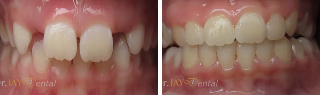 Before and after implant restoration case