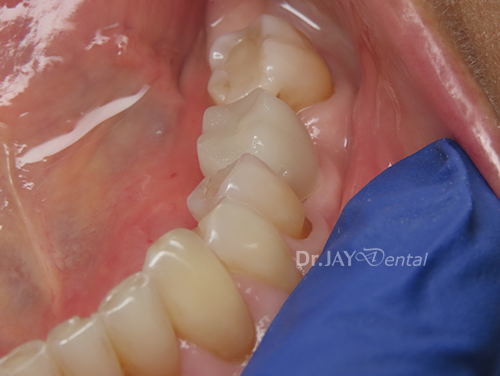 Case 1 after ceramic implant treatment