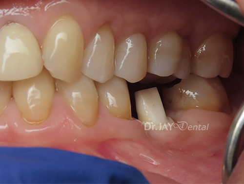 Case 1 before ceramic implant treatment