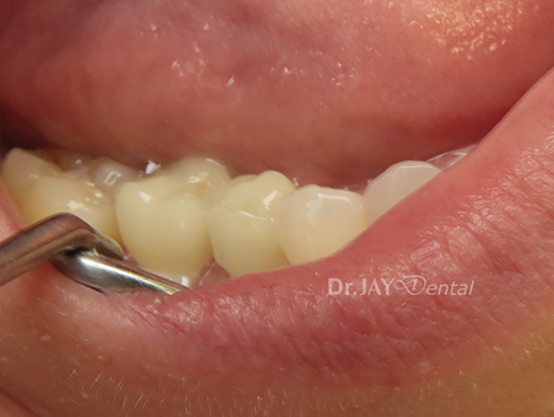 Case 12 after ceramic implant treatment