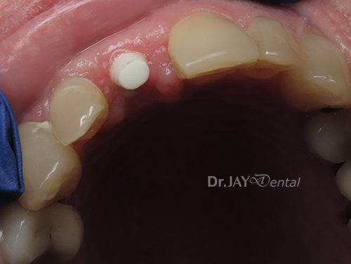 Case 2 before ceramic implant treatment