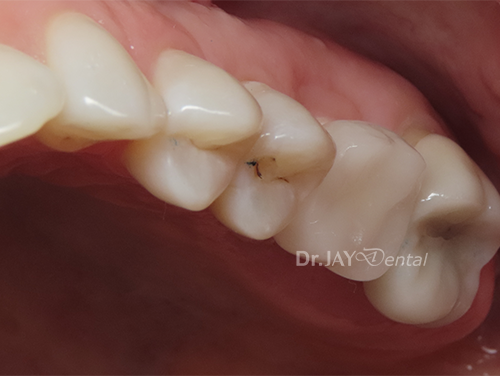 Case 3 after ceramic implant treatment