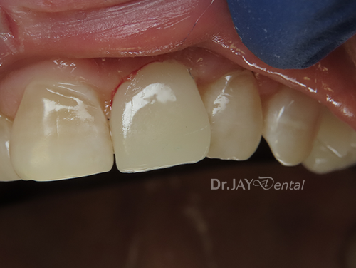 Case 6 after ceramic implant treatment