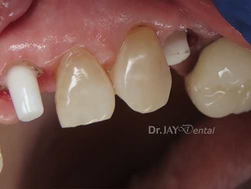 Case 6 before ceramic implant treatment