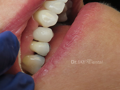 Case 8 after ceramic implant treatment