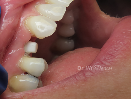 Case 8 before ceramic implant treatment