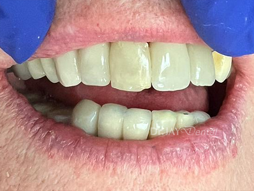 Front teeth after ceramic implant treatment