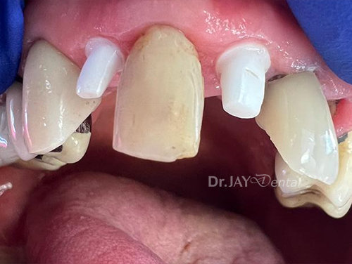 Front teeth before ceramic implant treatment