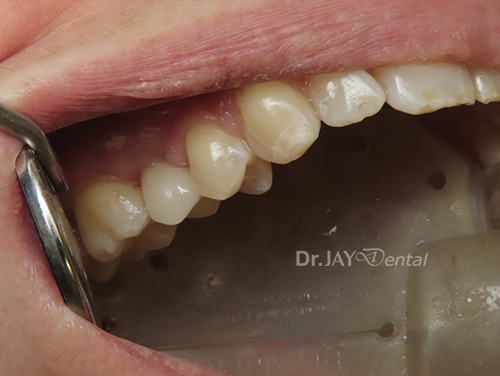 Case 10 after ceramic implant treatment