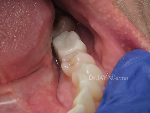 Molar site after ceramic implant treatment