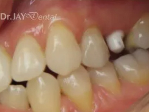 Case 14 ceramic implant treatment