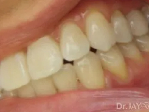 Case 14 ceramic implant treatment