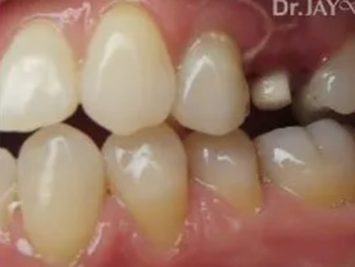 Case 14 ceramic implant treatment