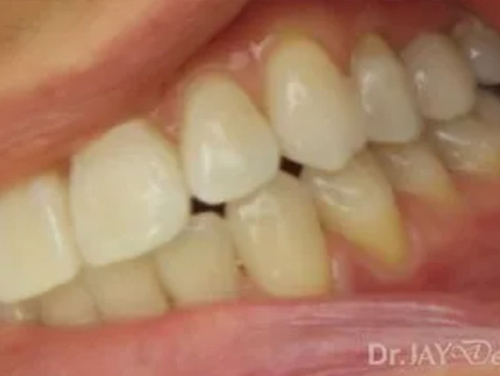 Case 14 ceramic implant treatment