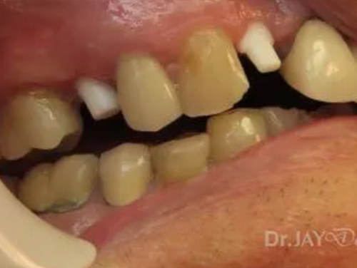 Case 15 ceramic implant treatment