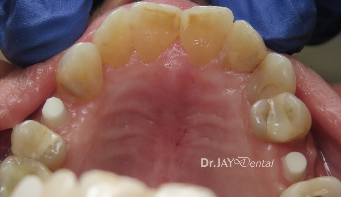 Case 7 ceramic implant treatment
